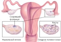 поли